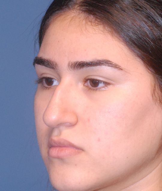 Rhinoplasty Before & After