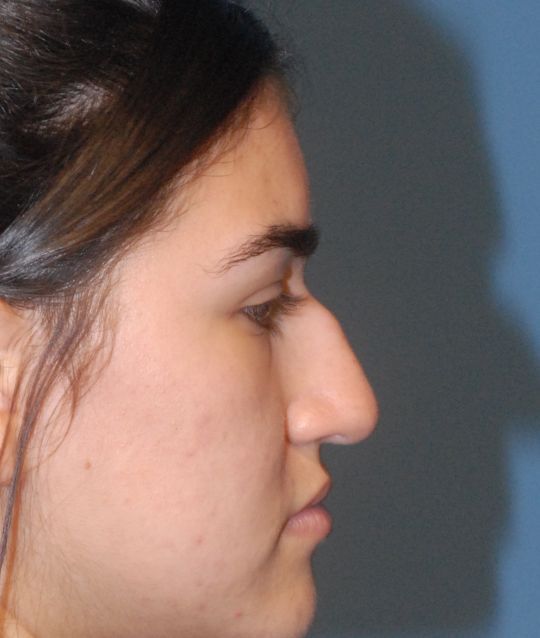 Rhinoplasty Before & After