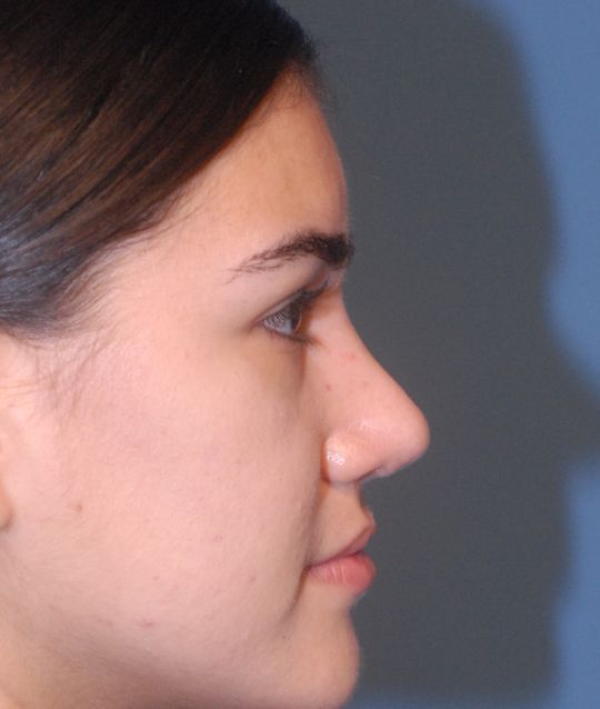 Rhinoplasty Before & After