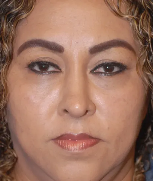 Rhinoplasty Before & After