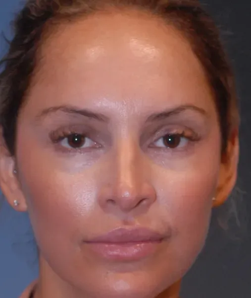 Rhinoplasty Before & After