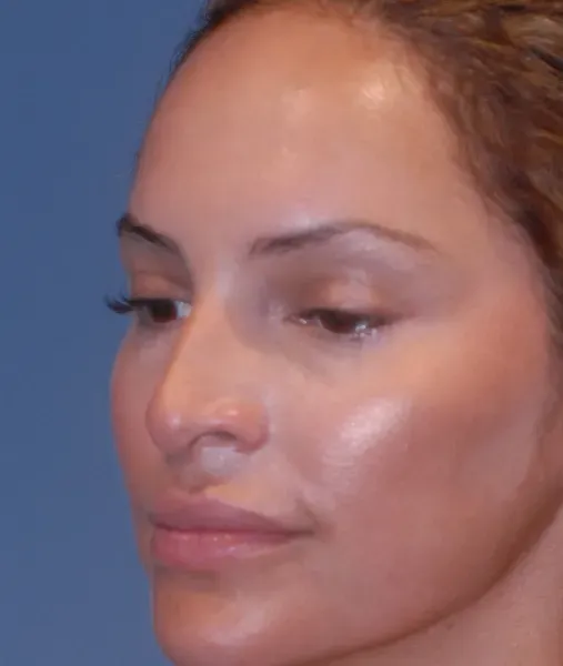 Rhinoplasty Before & After