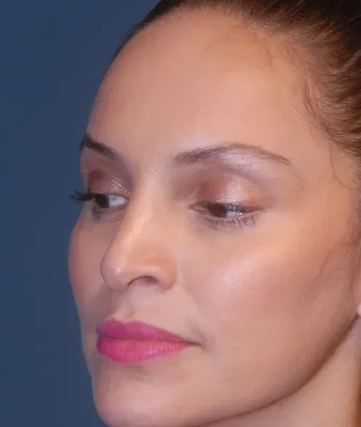 Rhinoplasty Before & After