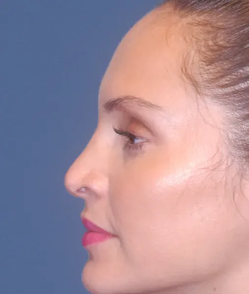 Rhinoplasty Before & After