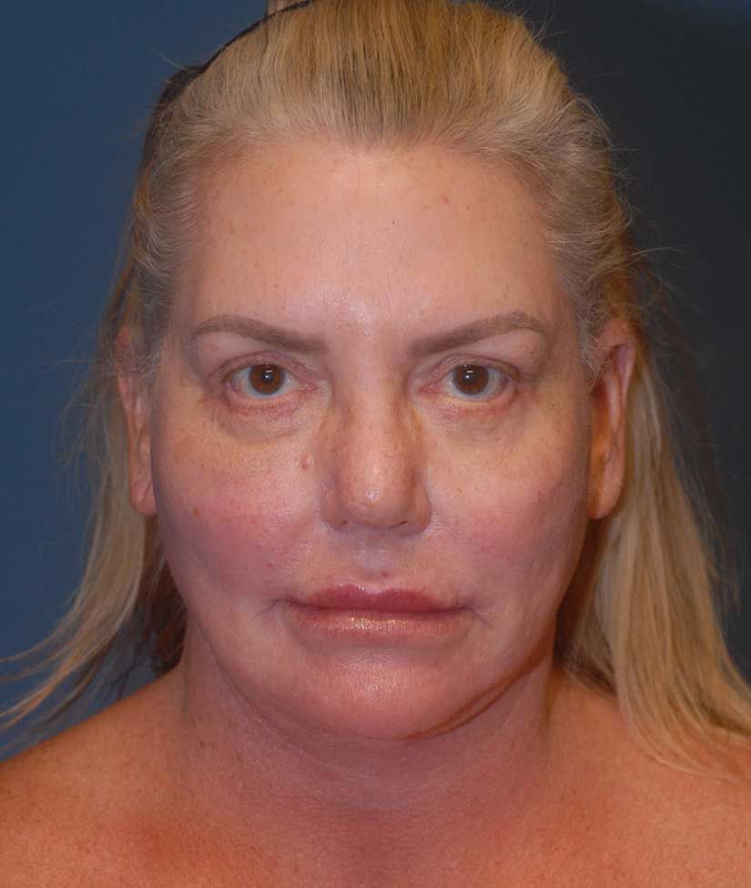 Rhinoplasty Before & After