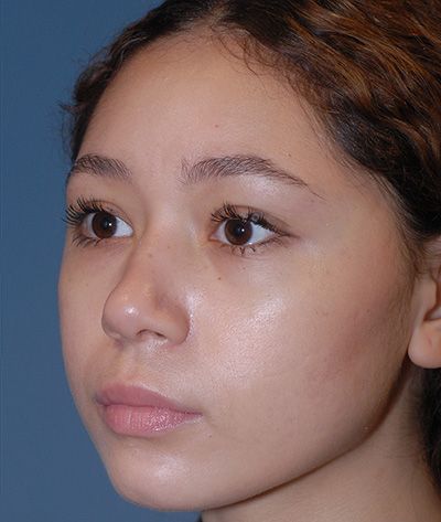 Rhinoplasty Before & After