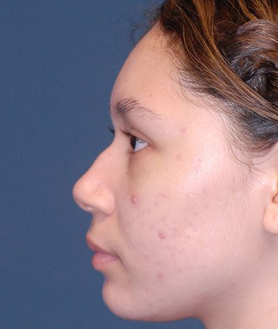 Rhinoplasty Before & After
