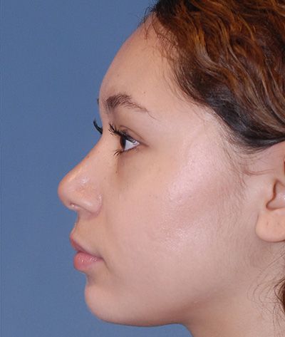 Rhinoplasty Before & After