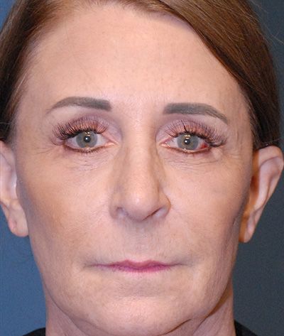 Rhinoplasty Before & After