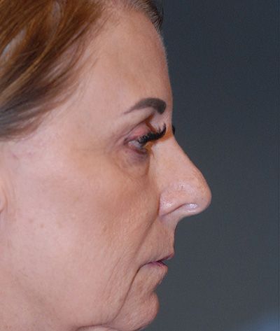 Rhinoplasty Before & After