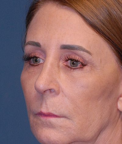 Rhinoplasty Before & After