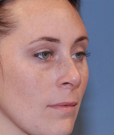 Rhinoplasty Before & After