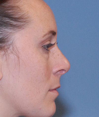 Rhinoplasty Before & After