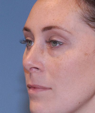 Rhinoplasty Before & After