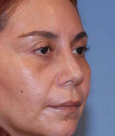 Rhinoplasty Before & After