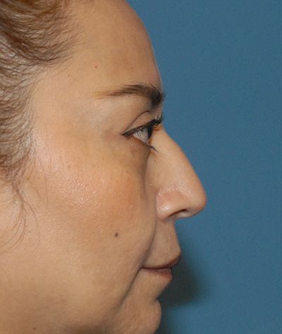 Rhinoplasty Before & After