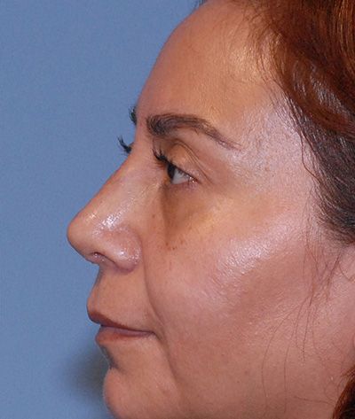 Rhinoplasty Before & After