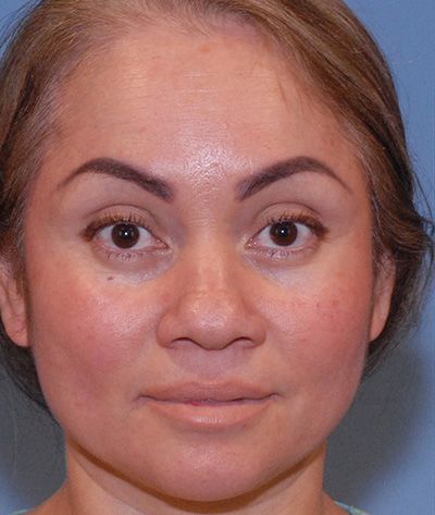 Rhinoplasty Before & After