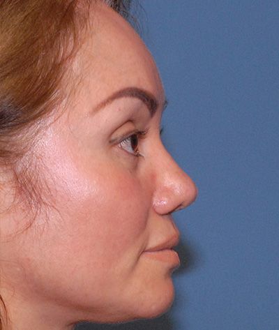 Rhinoplasty Before & After