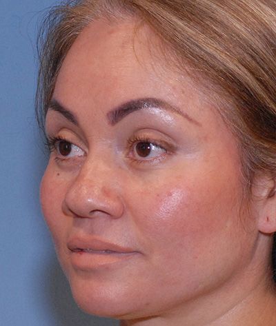 Rhinoplasty Before & After