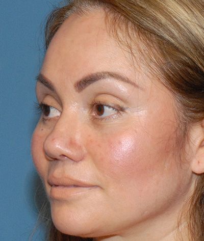 Rhinoplasty Before & After