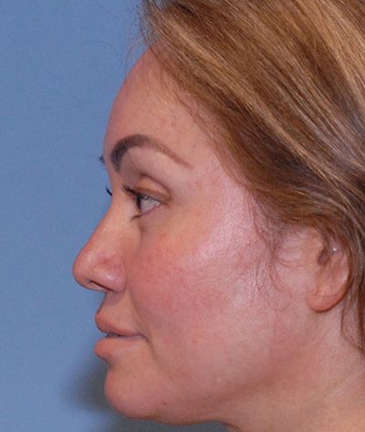 Rhinoplasty Before & After