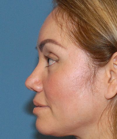 Rhinoplasty Before & After