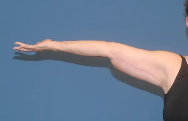 Arm Lift Before & After