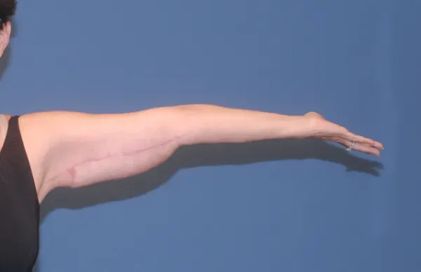 Arm Lift Before & After