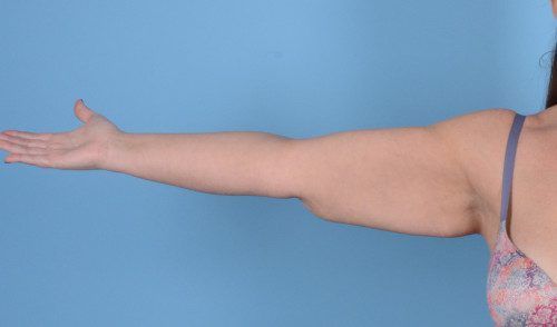 Arm Lift Before & After