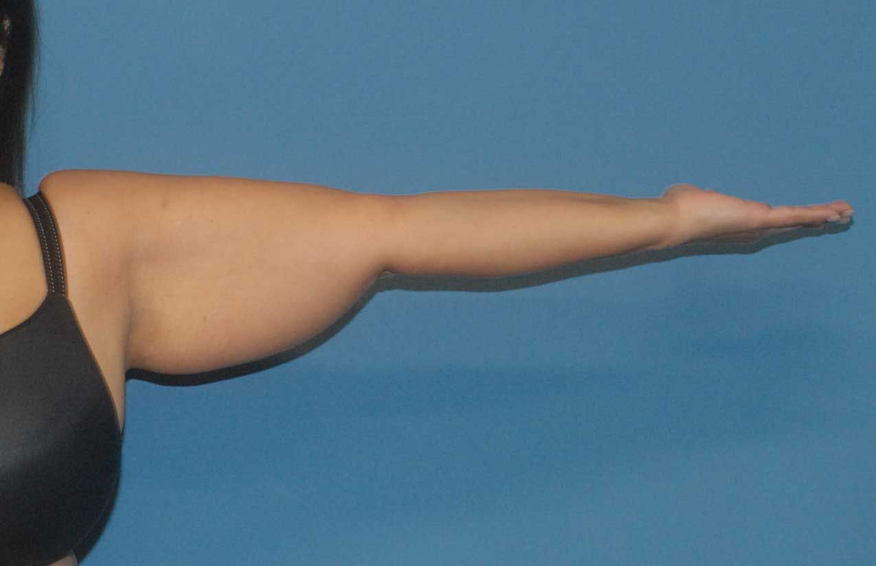 Arm Lift Before & After