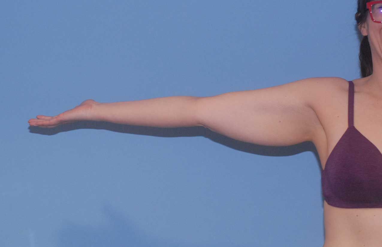Arm Lift Before & After