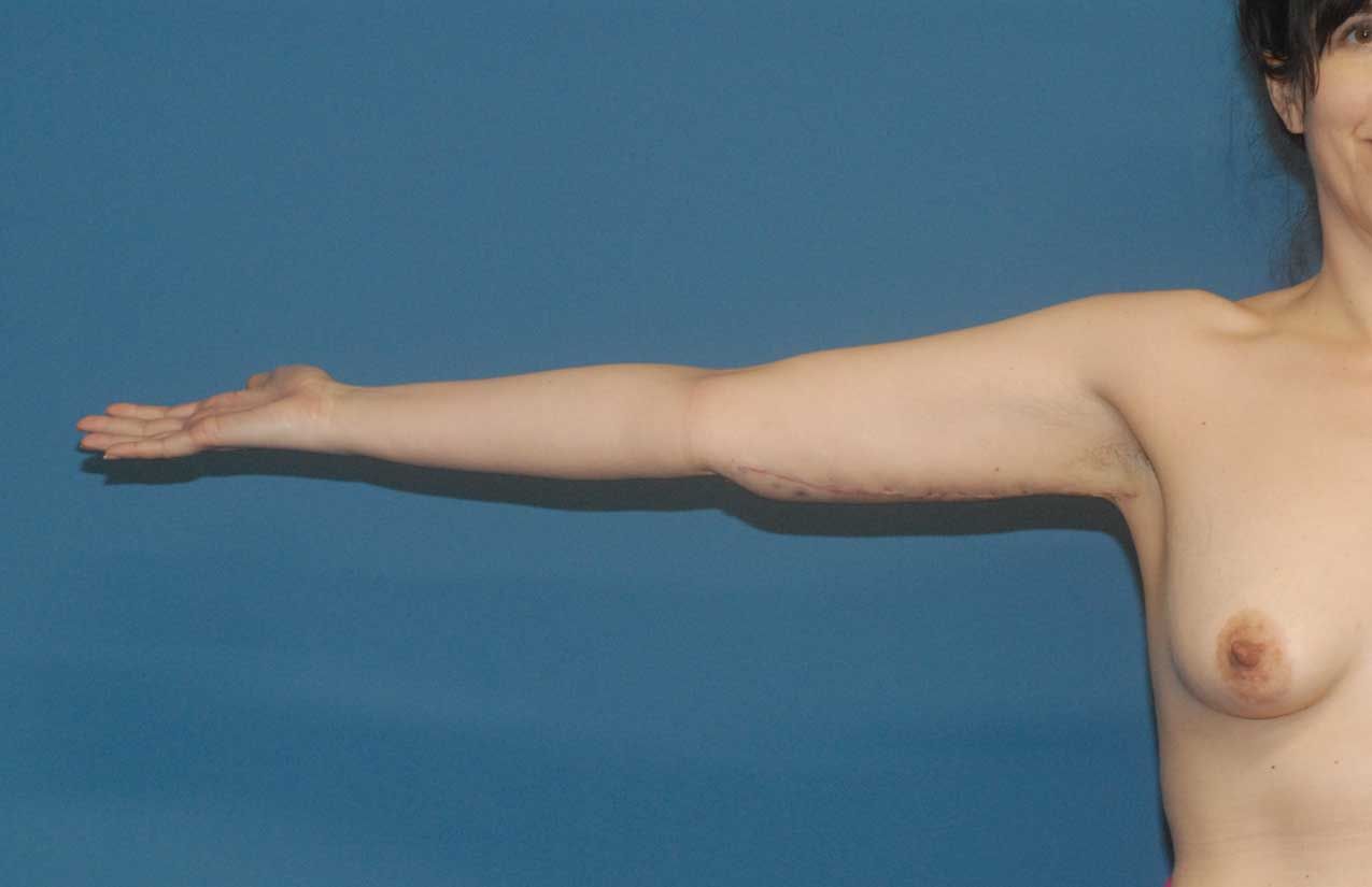 Arm Lift Before & After