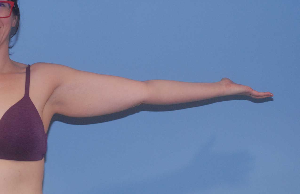 Arm Lift Before & After