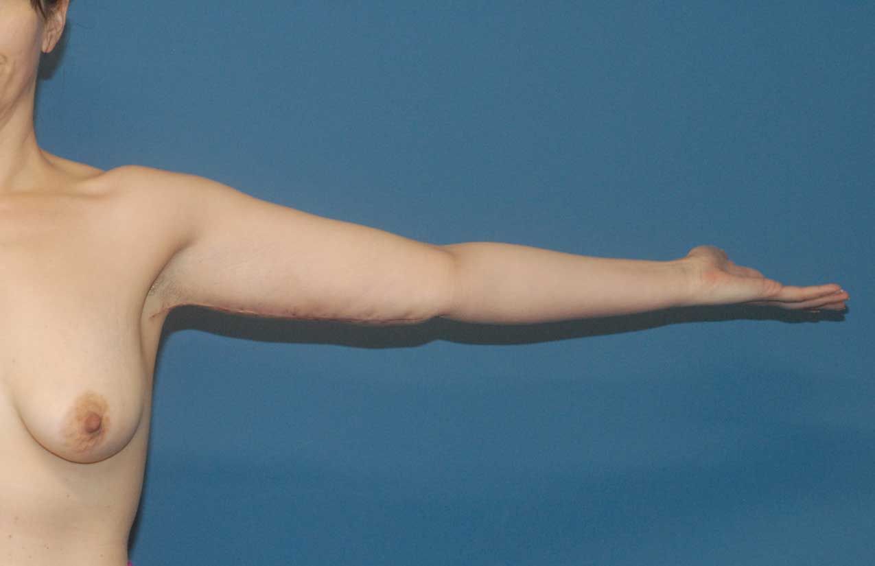 Arm Lift Before & After