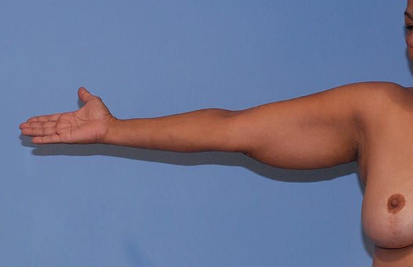 Arm Lift Before & After