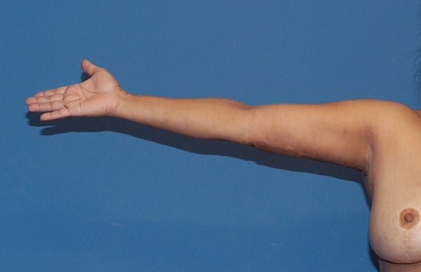 Arm Lift Before & After