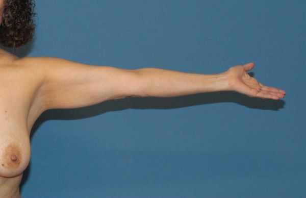 Arm Lift Before & After