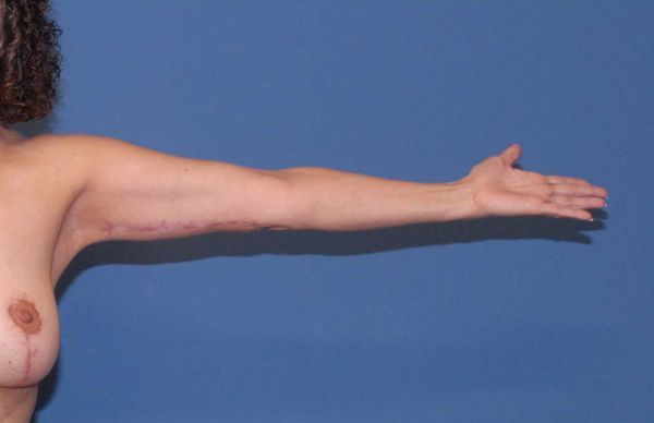 Arm Lift Before & After