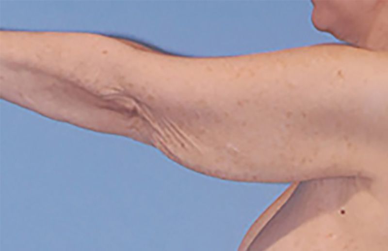 Arm Lift Before & After