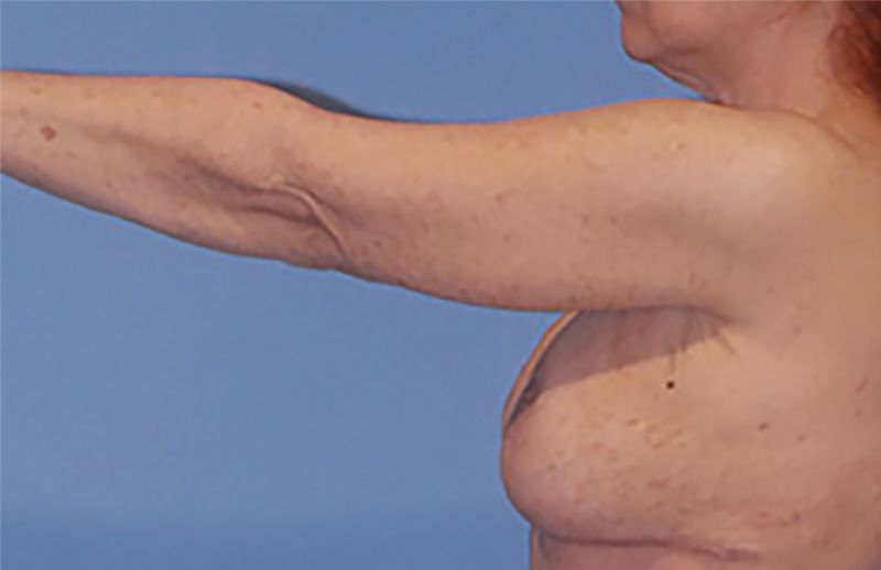 Arm Lift Before & After