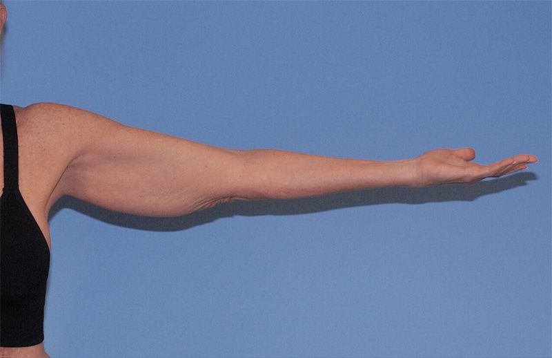 Arm Lift Before & After