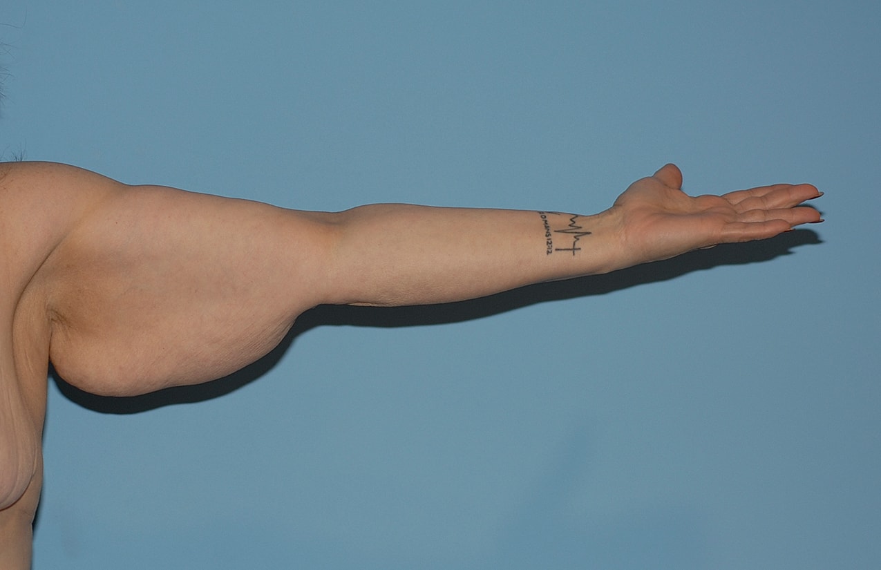 Arm Lift Before & After