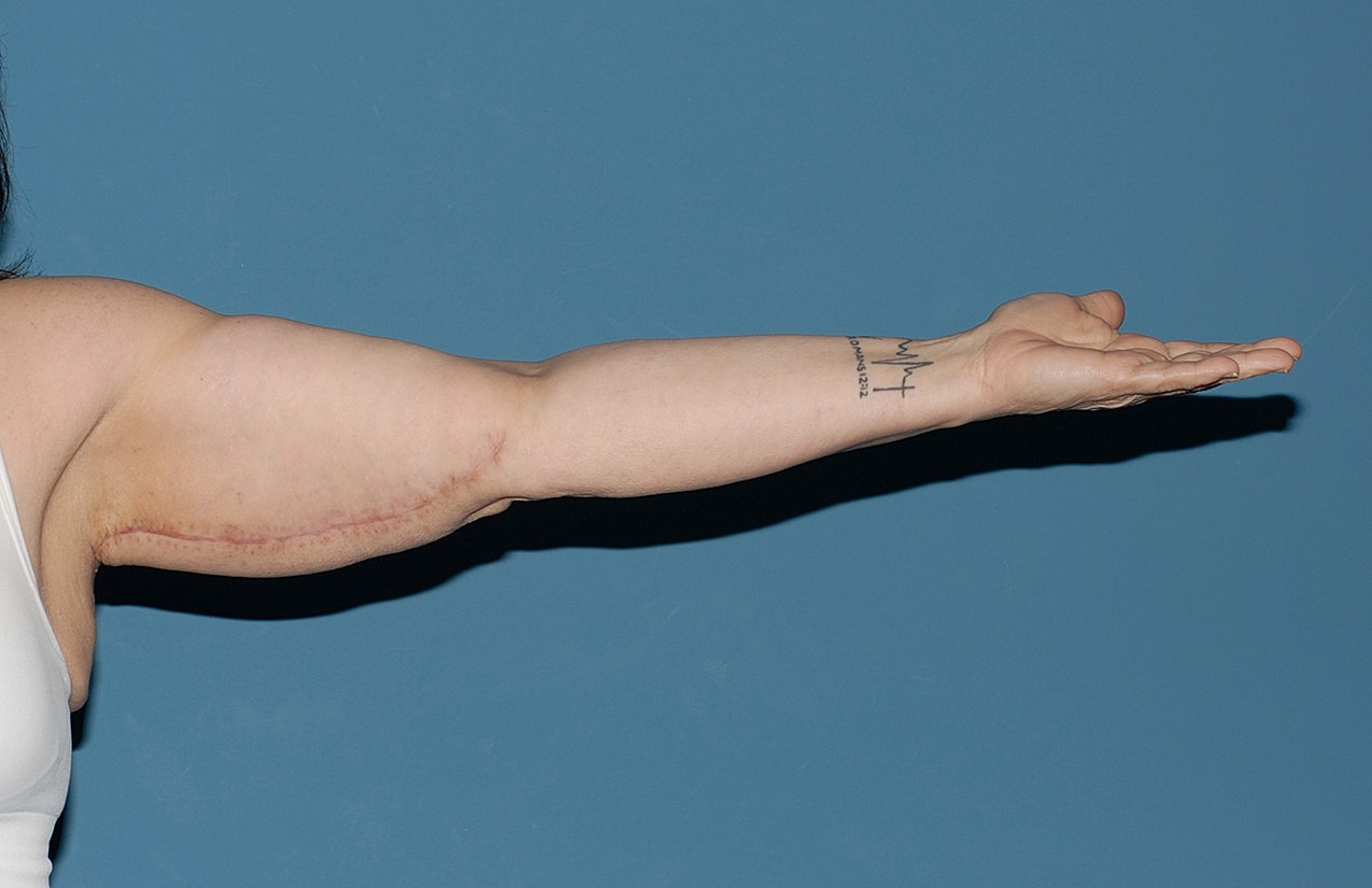 Arm Lift Before & After