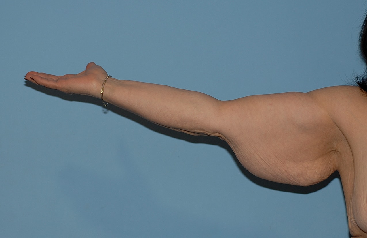 Arm Lift Before & After