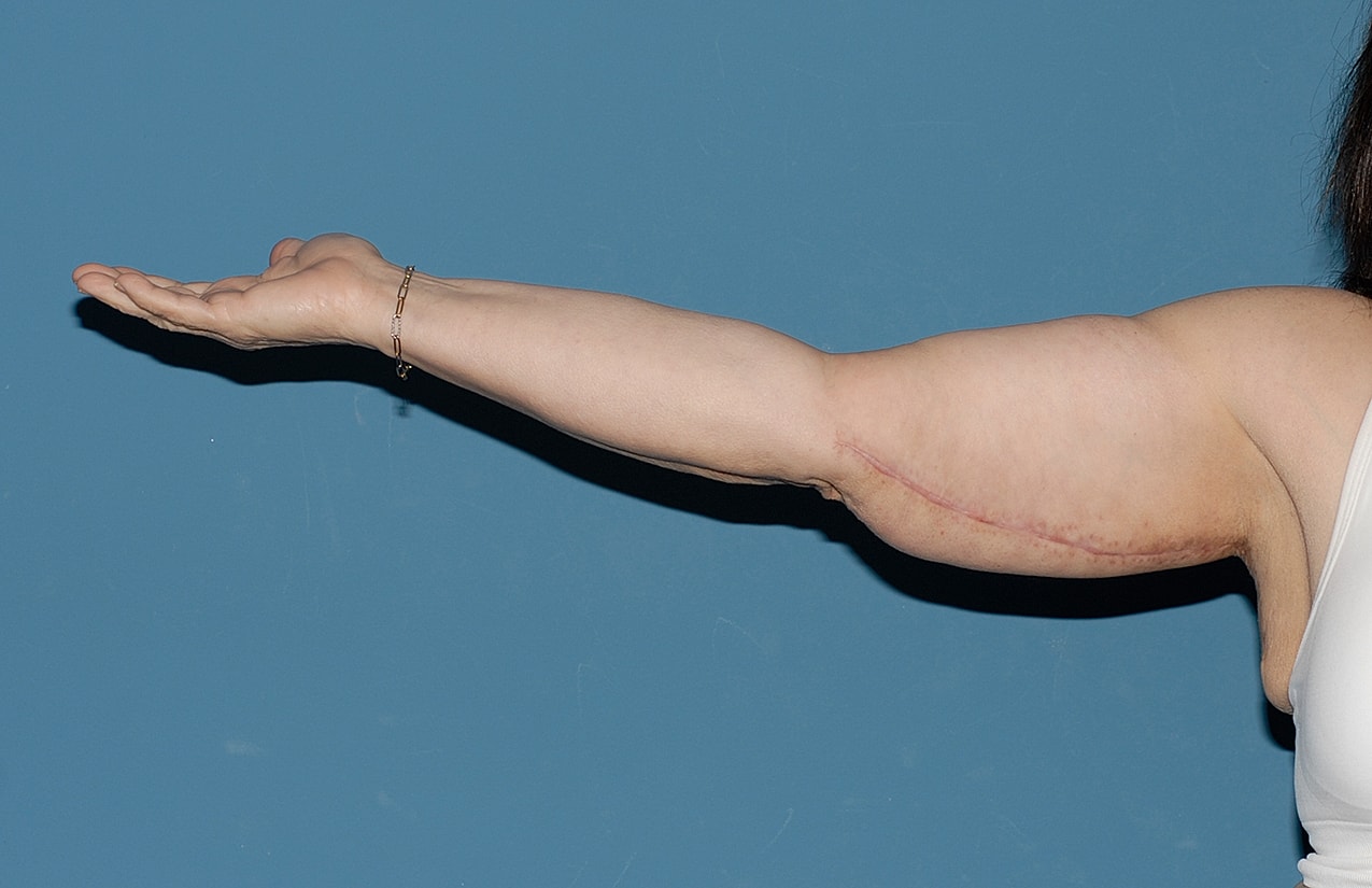 Arm Lift Before & After