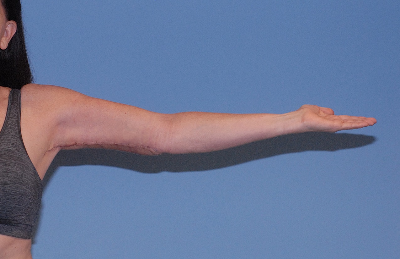 Arm Lift Before & After