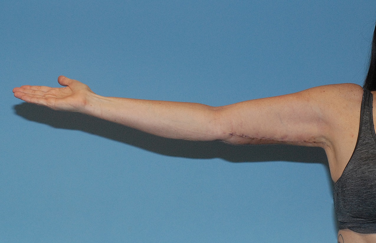 Arm Lift Before & After