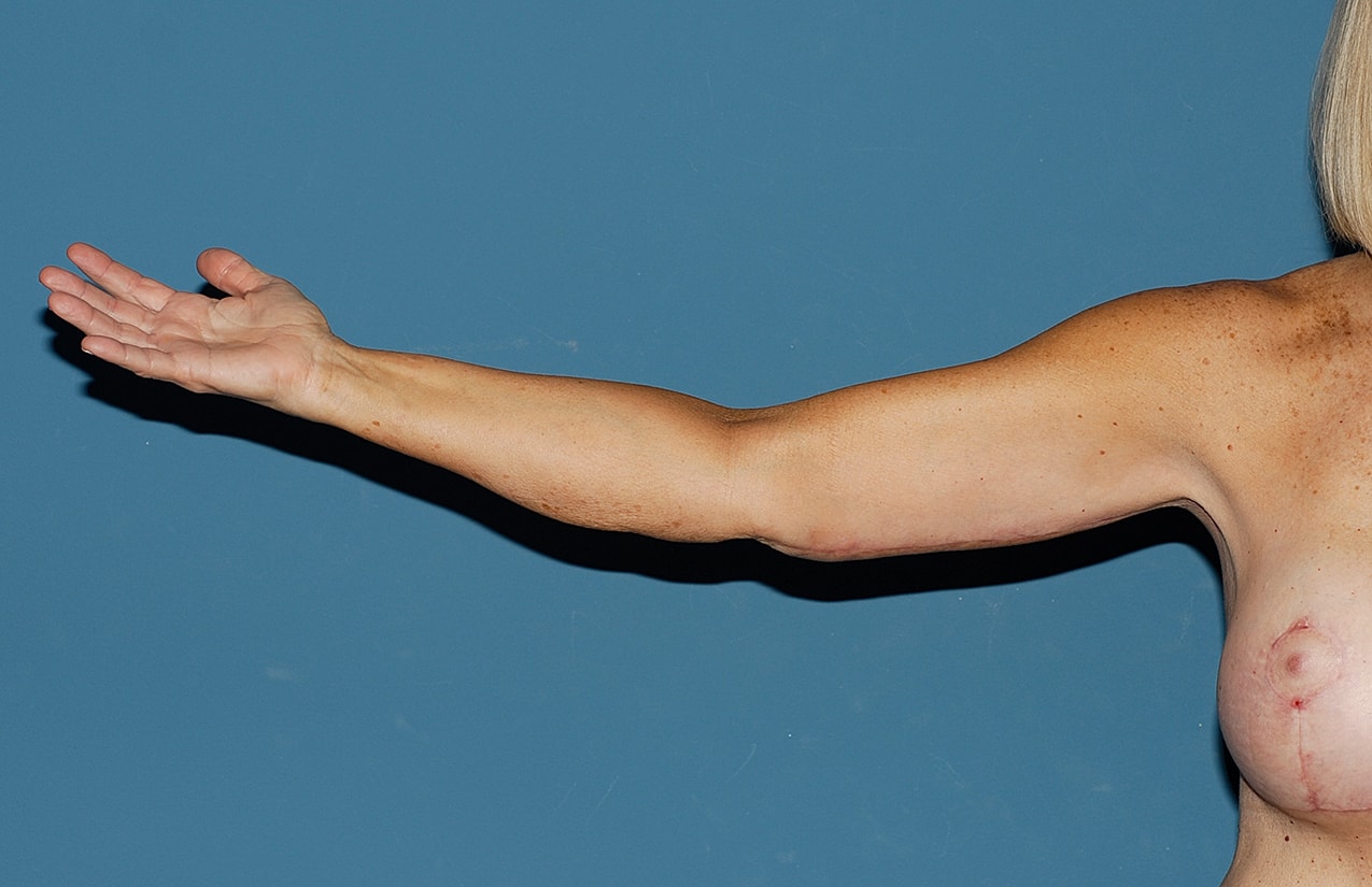 Arm Lift Before & After