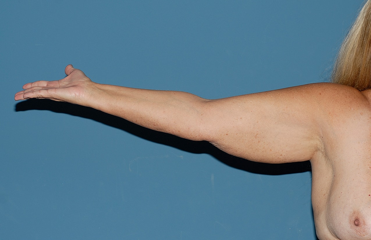 Arm Lift Before & After
